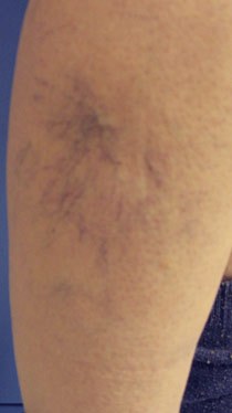 Before and after results of Microsclerotherapy