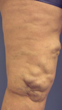 Before and after results of Phlebectomy