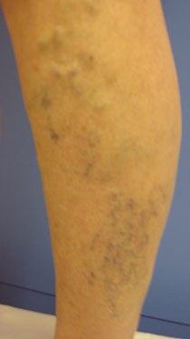 Before and after results of Ultrasound Guided Sclerotherapy