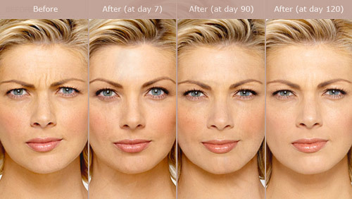 Botox before and after