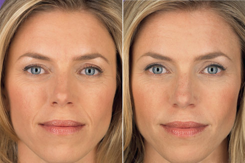 Juvederm before and after