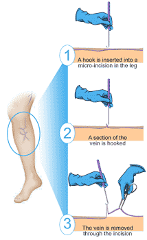 Phlebectomy